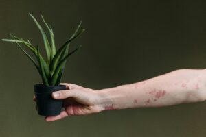 eczema and psoriasis on the arm holding a aloe plant